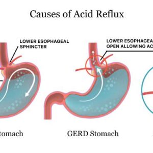 Causes-of-Acid-Reflux