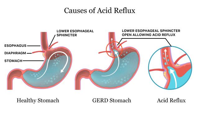 gastroesophageal-reflux-disease-gerd-medical-nutritional-therapy