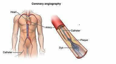 Cardiac-Catheterization