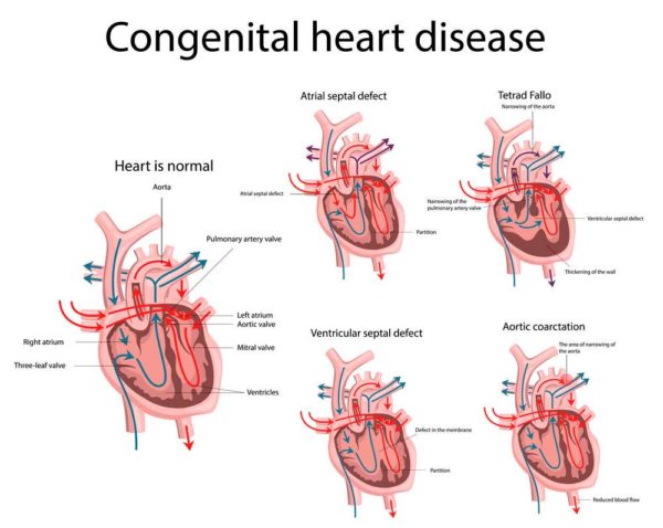 Congential-Heart-Disease