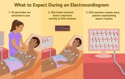 Electrocardiogram