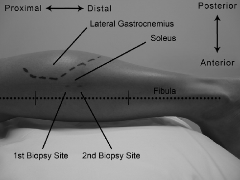 Nerve-or-Muscle-Biopsy