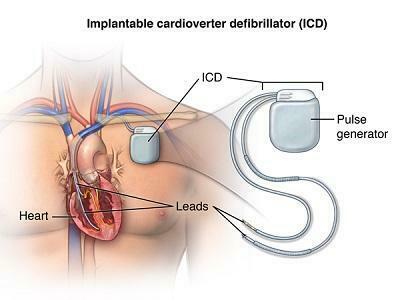 Pacemakers