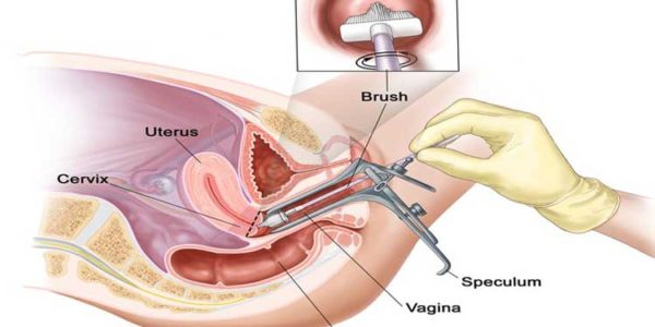 Pap-smear-abnormalities