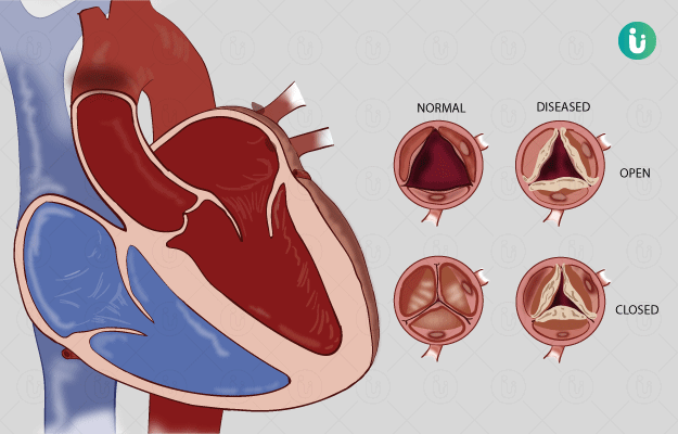 Rheumatic Heart Disease