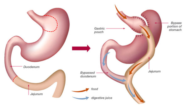 Gastric Bypass