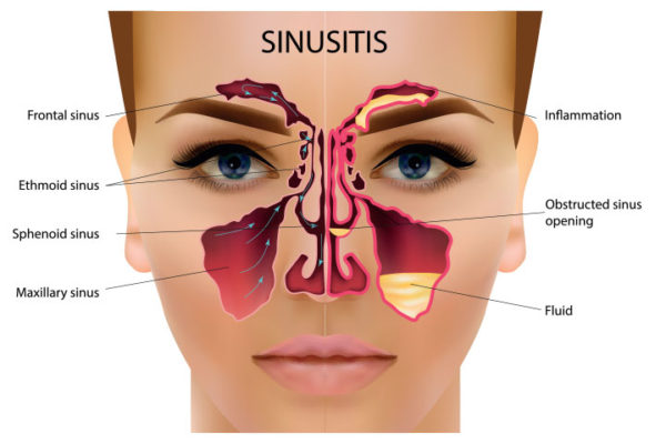 Sinus-infection