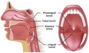 Tonsillitis