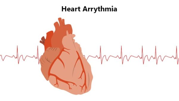 heart-arrhythmia