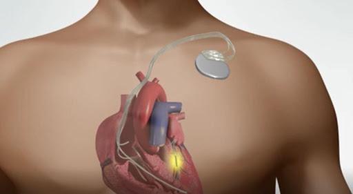 What is a Pacemaker?