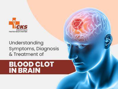 A Guide to Symptoms, Causes, and Treatment of Brain Blood Clots